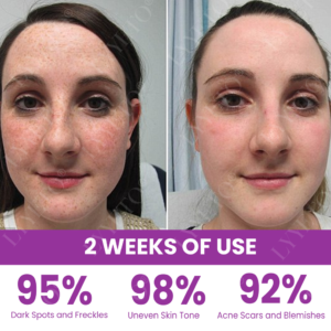 Lyyeto® MelantraX Advanced Brightening Essence ACE