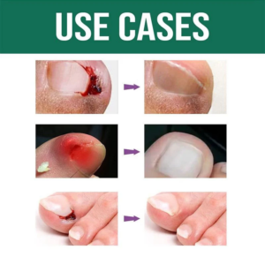 Rubriel Anti Paronychia Relief Oil