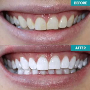 LIMETOW™ Instant Teeth Whitening Paint image LIMETOW™ Instant Teeth Whitening Paint