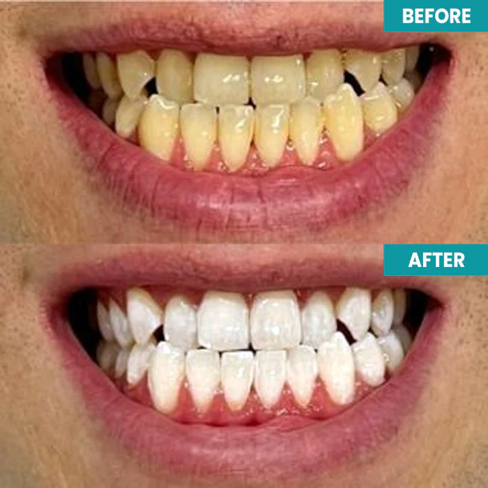 LIMETOW™ Instant Teeth Whitening Paint image LIMETOW™ Instant Teeth Whitening Paint