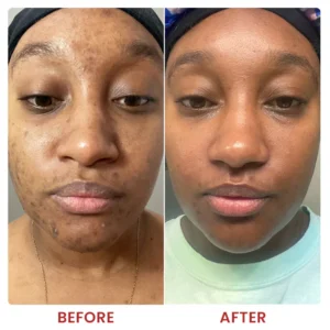 LIMETOW® Dark Spots Essence