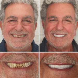 Custom-SET Functional Dentures