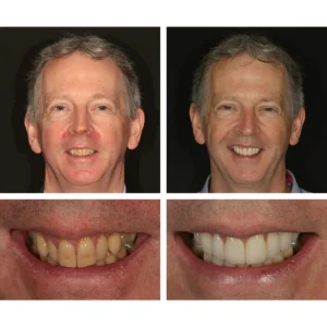 LIMETOW™ Teeth Whitening Essence image LIMETOW™ Teeth Whitening Essence