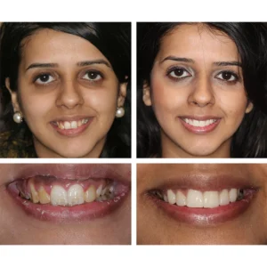LIMETOW™ Teeth Whitening Essence image LIMETOW™ Teeth Whitening Essence