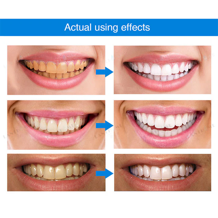 LIMETOW™ Teeth Whitening Essence image LIMETOW™ Teeth Whitening Essence
