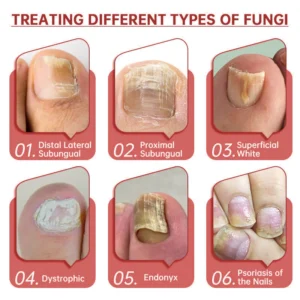 Cvreoz® Toenail Fungus Treatment image Cvreoz® Toenail Fungus Treatment