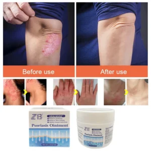 HealMusz Psoriasis and Eczema Cream