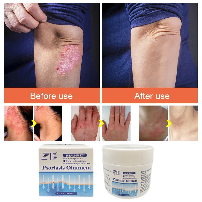 HealMusz Psoriasis and Eczema Cream