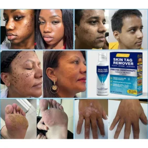 CVREOZ® TagRecede Cryo Treatment Spray image CVREOZ® TagRecede Cryo Treatment Spray