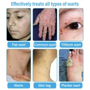 CVREOZ® TagRecede Cryo Treatment Spray image CVREOZ® TagRecede Cryo Treatment Spray