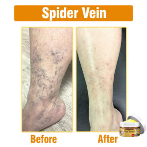 Flysmus® Bee Venom Comprehensive Cream image Flysmus® Bee Venom Comprehensive Cream