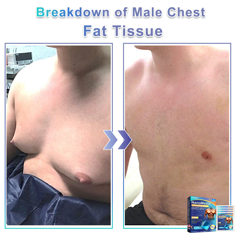 GFOUK® NanoMedix Gynecomastia Chest Fatburn & Firm Patch