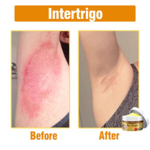 Flysmus® Bee Venom Comprehensive Cream image Flysmus® Bee Venom Comprehensive Cream