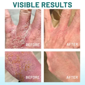 ODEIUN™ Probiotic + B 24-7 Moisture Eczema Relief Cream