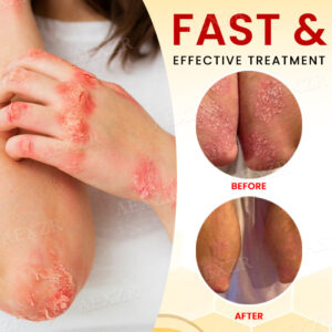 RZXEA™ Bee Venom Psoriasis Treatment Cream