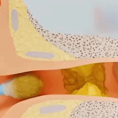 EarFlow™ Earwax Remover | Removes 95% of earwax in 60 seconds