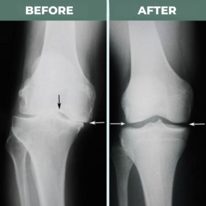 FlexiKnee™ Knee Brace | Walk pain-free in 7 days, guaranteed!