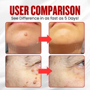 Dobshow® WartAway Pro Patches image See Results in 3-5 Days with Dobshow® WartAway Pro Patches.