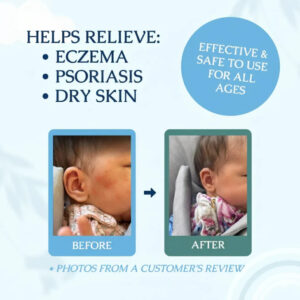 LOVILDS® Eczema & Psoriasis Cream image LOVILDS® Eczema & Psoriasis Cream