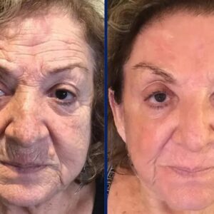 Elycura™ Liquid Solition