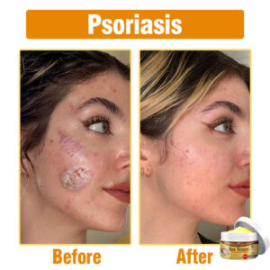 Flysmus® Bee Venom Comprehensive Cream image Flysmus® Bee Venom Comprehensive Cream