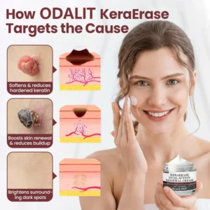 ODALIT®KeraErase Dual-Action Renewal Cream image ODALIT®KeraErase Dual-Action Renewal Cream
