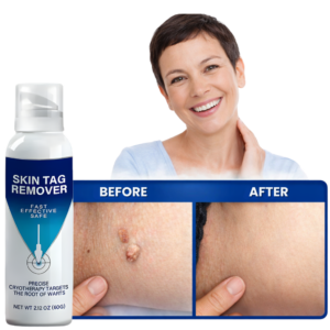 Dermaclear TagRecede Cryo Treatment