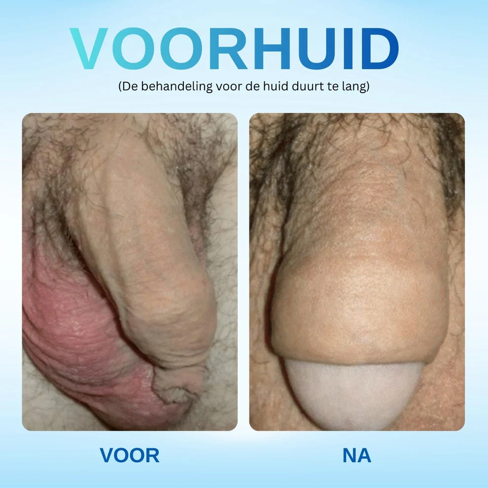 RZXEA™ Gel Tegen Overtollige Voorhuid