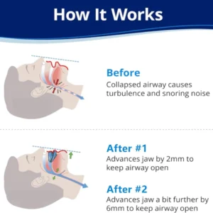 NESLEMY™ Anti-Snoring Mouthpiece-Good Evening Snore Solution image NESLEMY™ Anti-Snoring Mouthpiece-Good Evening Snore Solution