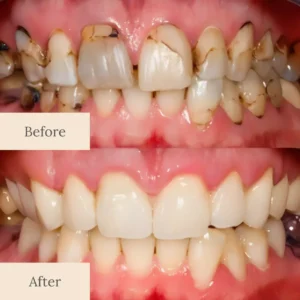 LBMLBM™ Teeth Armor Drops image LBMLBM™ Teeth Armor Drops