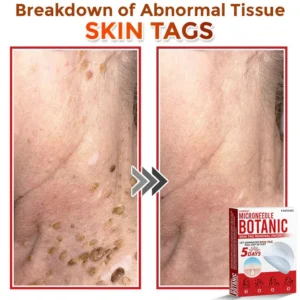 Yunpso™ MicroNeedle Botanic Skin Tag Removal Patch