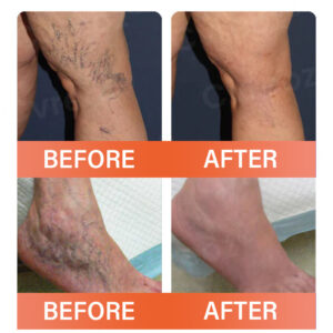 AQA™ VeinEase Microneedle Therapy Patch