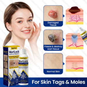 Healrize® WartLock Cryo-Recovery Cooling Spray