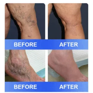 Ourlyard® Vein Ease Microneedle Care Patch – Cuttable