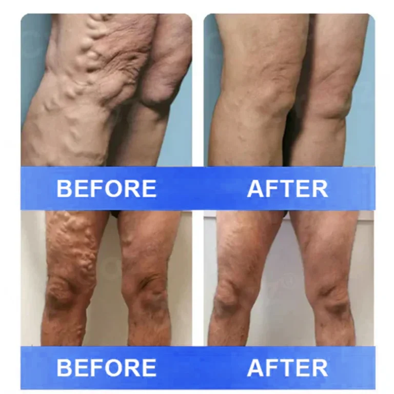 Ourlyard® Vein Ease Microneedle Care Patch – Cuttable