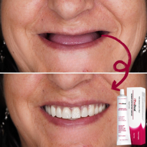 ProDent™ Denture Adhesive & Fixative | Secures 95% of Dentures Firmly and Helps Prevent Irritation for a Worry-Free Smile in Just 7 Days