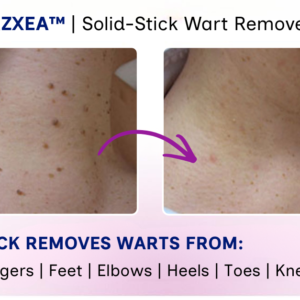RZXEA™ Solid-Stick Wart Remover