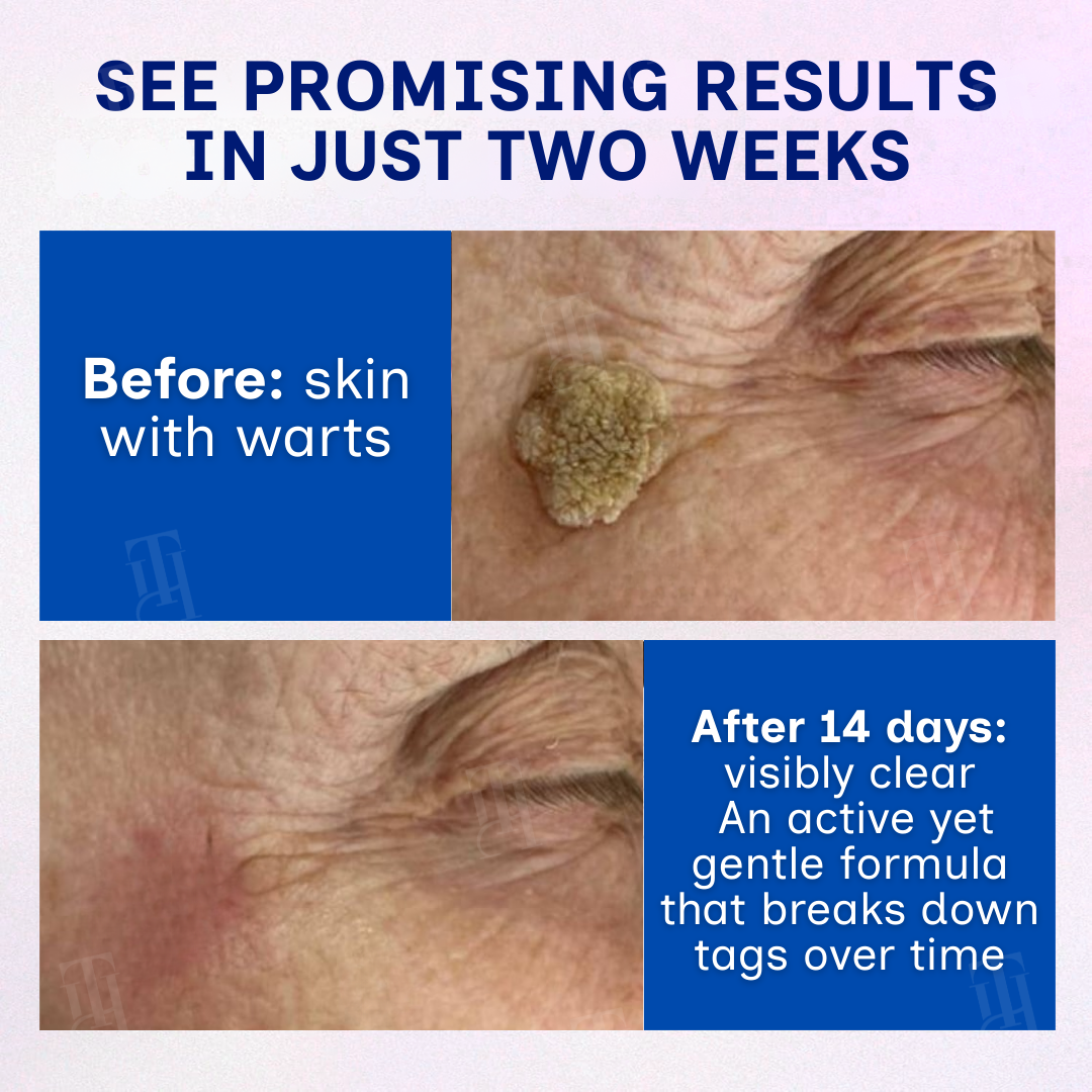 RZXEA™ Solid-Stick Wart Remover