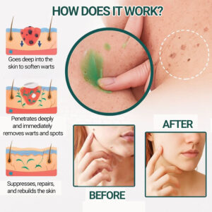 Elycura | Clinically proven to remove 95% of moles, warts, and skin imperfections - permanently in just 3 days!
