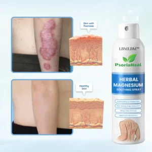LBMLBM™ PsoriaHeal Herbal Magnesium Soothing Spray