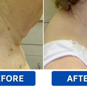 RZXEA™ Solid-Stick Wart Remover