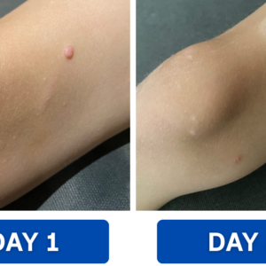 RZXEA™ Solid-Stick Wart Remover