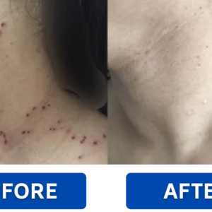 RZXEA™ Solid-Stick Wart Remover