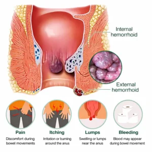 YUNPSO® SootheMist PRO Hemorrhoid Spray