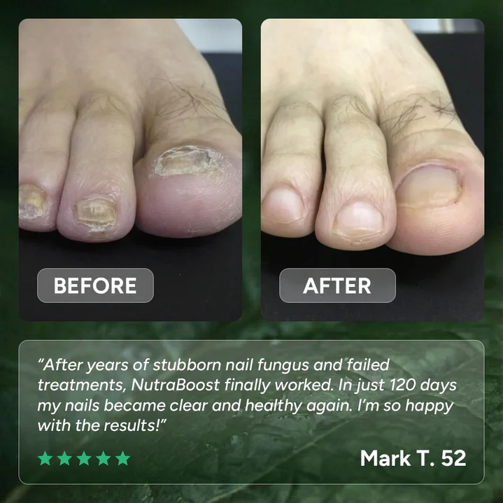 Nutraboost Nail Fungus Treatment Gel