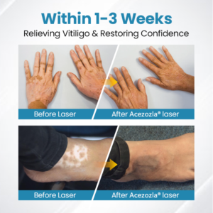 Acezozla® DermaBeam Vitiligo Therapy Device