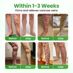 Healrize® VeinHeal Microneedle Patch