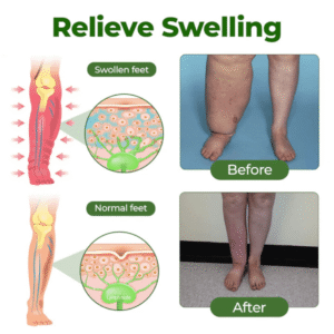 Relieflogix Edema Relief Lotion