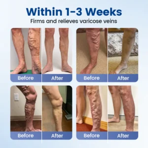 Timilk® Vein Ease Microneedle Therapy Patch