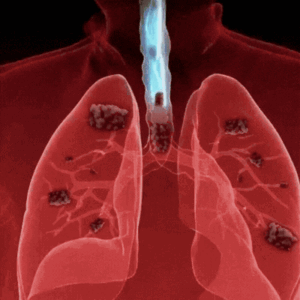 Pulmora™ | Remove 93% Toxins from Your Lungs Naturally in 5 Days!